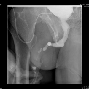 Cystourethrogram from early November showing how my urethra was almost completely blocked