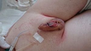 Penis with stitches and an open wound covering about a third of the underside.