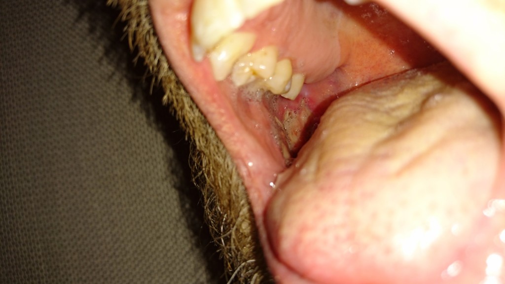 Healing wound inside the right cheek, tongue and teeth partially obscuring