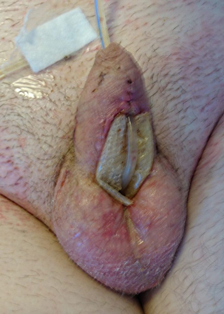 My penis with the dressing over the graft and urethral catheter in place, just before they were removed.