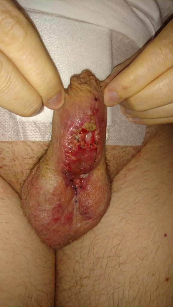 My penis after the catheters and dressing were removed. You can see the temporary urethral outlet at the top of my scrotum, then the pink graft and then the whitish part is the original urethra.